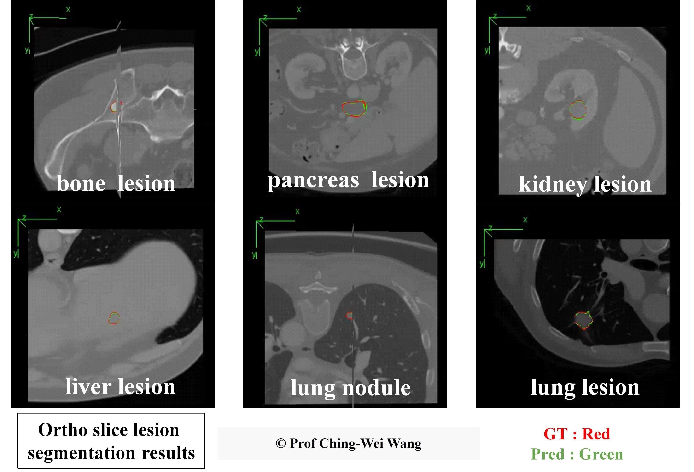 Professor Ching-Wei Wang's team from the Graduate Institute of Biomedical Engineering at Taiwan Tech has developed a universal AI model for precise 3D segmentation of various lesions. In the images, red contours represent the baseline truth, while green contours show the model's predictions.