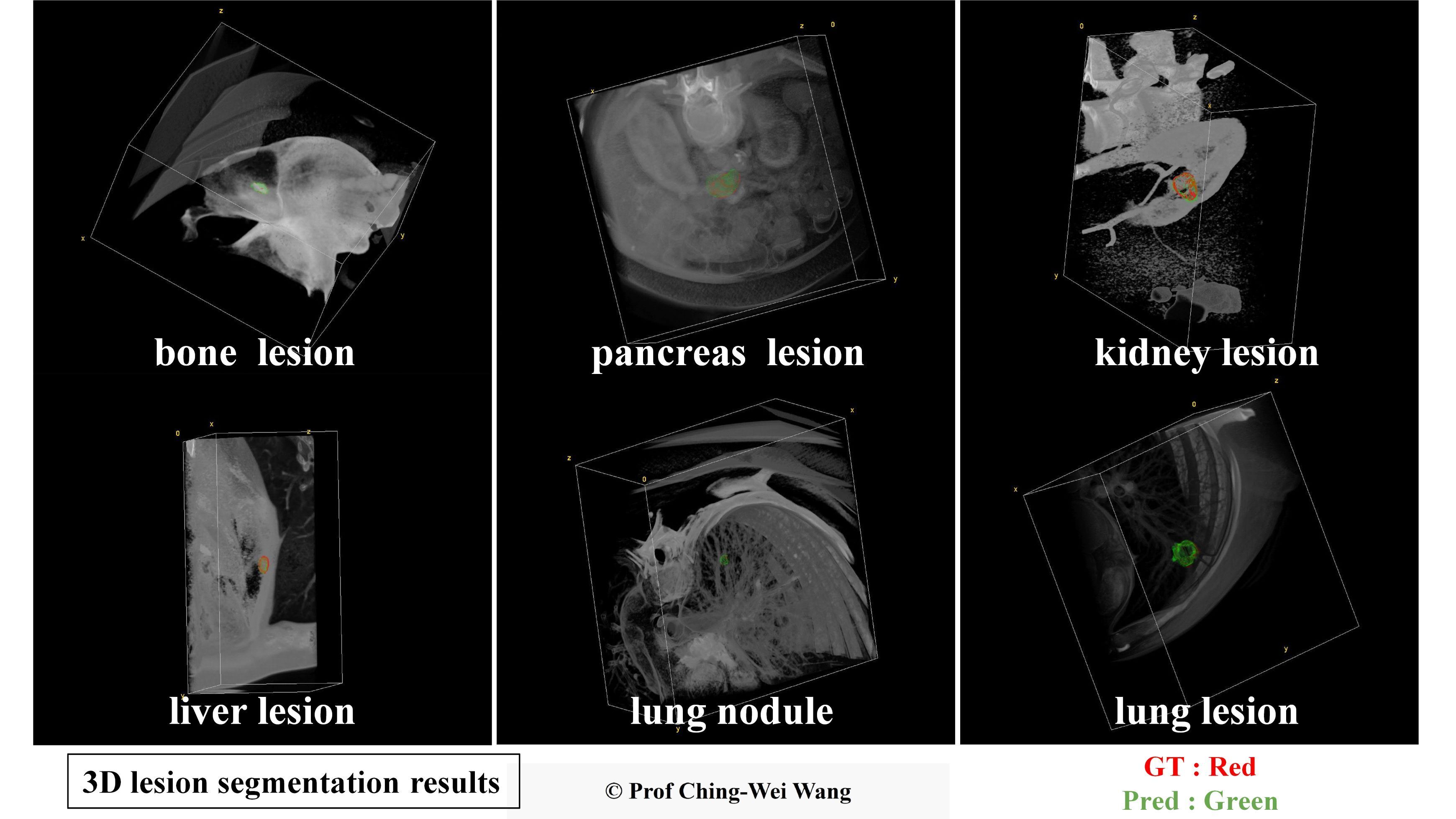 Professor Ching-Wei Wang's team has developed a universal AI model for precise 3D segmentation of various lesion types. In the images, the red contours represent the baseline truth, while the green contours represent the model's predictions.