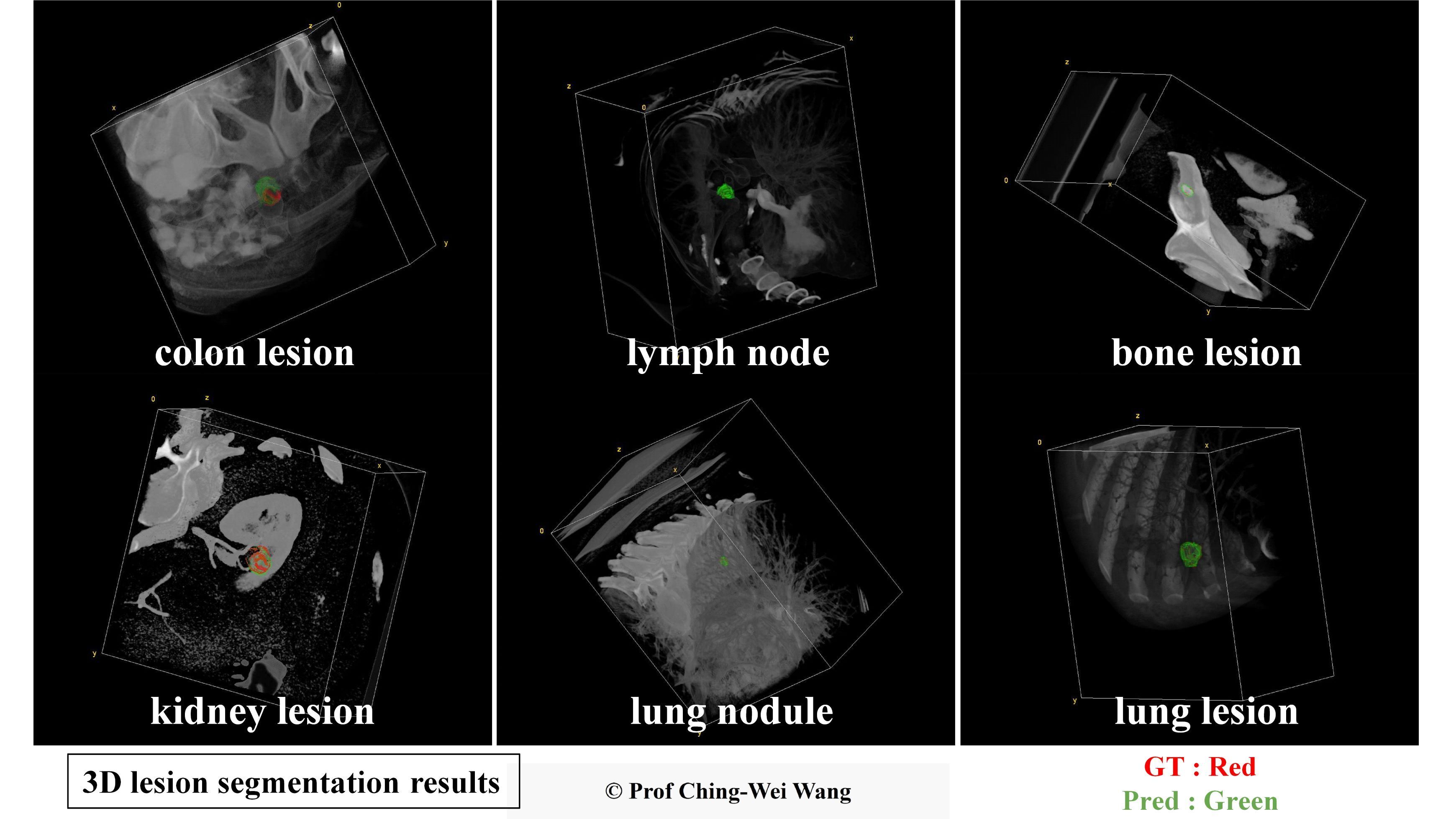 Professor Ching-Wei Wang's team has developed a universal AI model for precise 3D segmentation of various lesion types. In the images, the red contours represent the baseline truth, while the green contours represent the model's predictions.